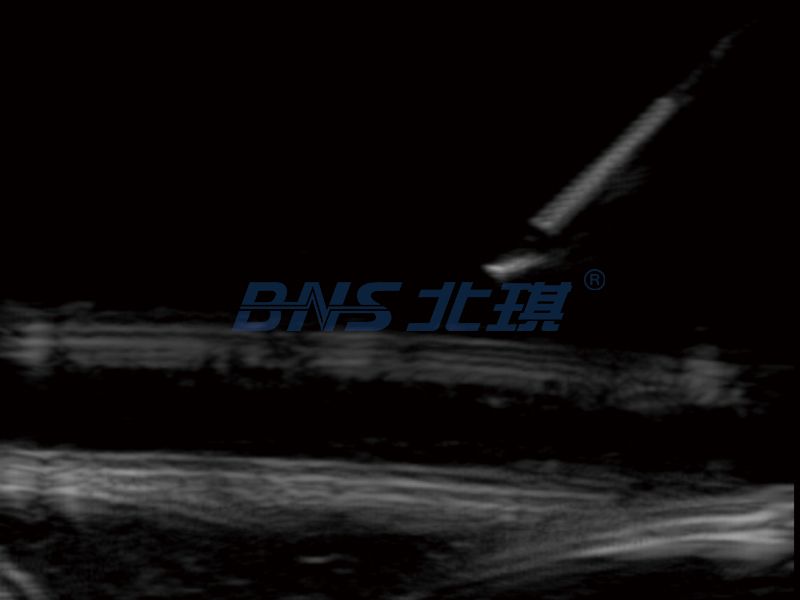 一次性使用射频穿刺套管针